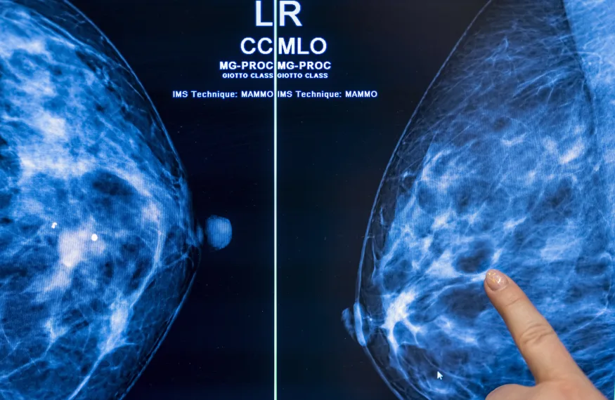 Cancerscreening med artificiell intelligens kan halvera radiologernas arbetsbörda - studie
