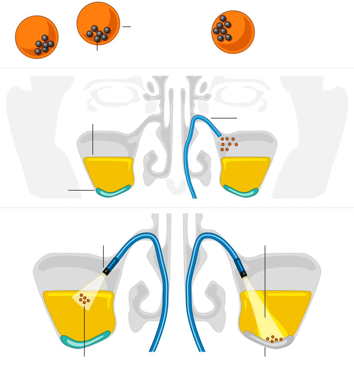 Illustration av mikrorobotar för behandling av bihåleinflammation